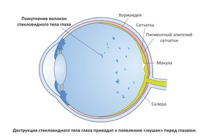 Мушки перед глазами